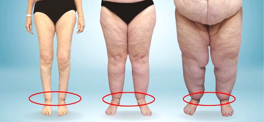 Effektive Behandlung bei Lipödem: Welche Therapie hilft wirklich?