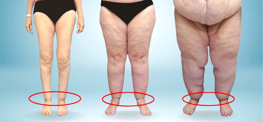 Effektive Behandlung bei Lipödem: Welche Therapie hilft wirklich?